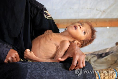 지난 2일(현지시간) 예멘 하자주의 한 병원에서 4살 아이가 영양실조로 인해 치료를 받고 있다. [AFP=연합뉴스 자료사진]